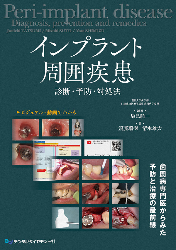 【6月の新刊】インプラント周囲疾患　診断・予防・対処法