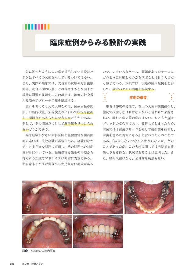 1歯欠損から1歯残存までを補綴する Best Denture Design 【増補改訂版】