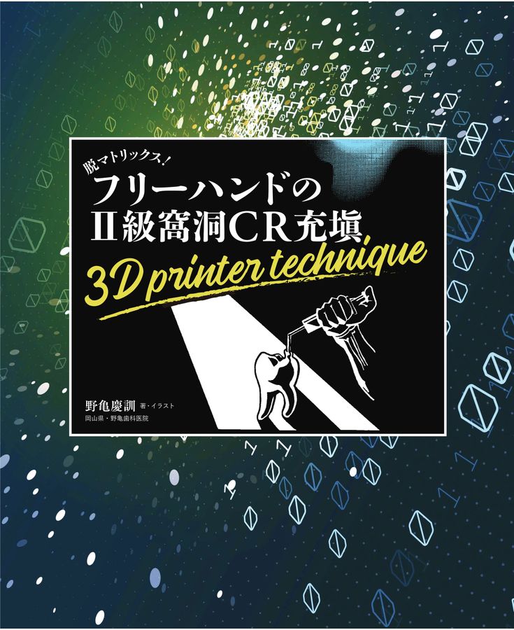 フリーハンドの II級窩洞CR充填 3D printer technique 脱マトリックス！フリーハンドのII級窩洞CR充填 3D printer technique