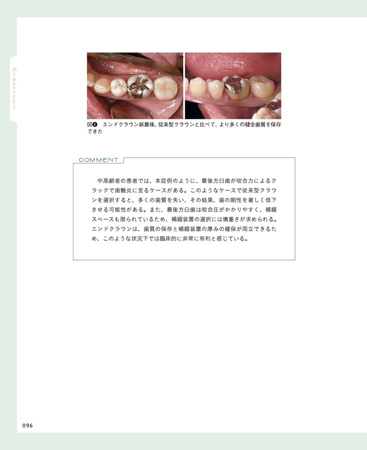 エンドクラウン 理論と実践を徹底解説