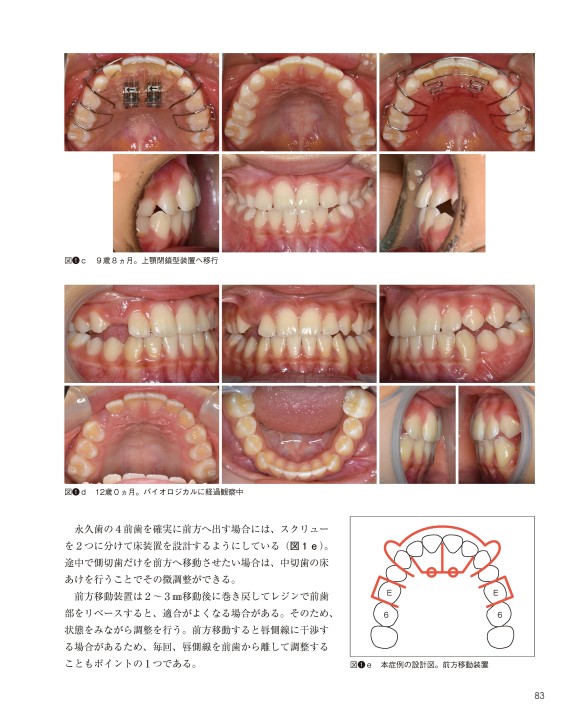 GPのための床矯正治療を成功させる床装置と設計