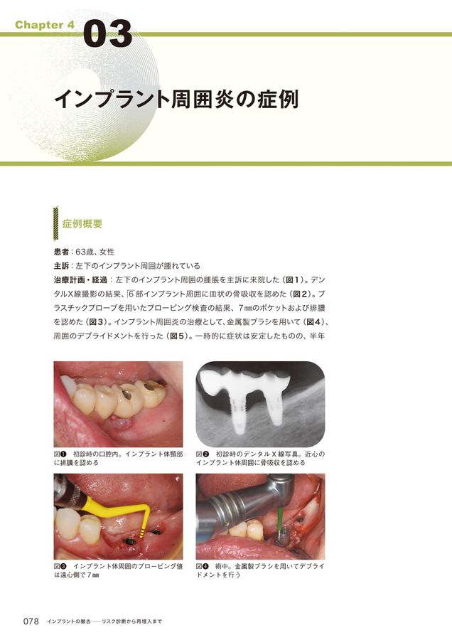 インプラントの撤去 ～リスク診断から再埋入まで～