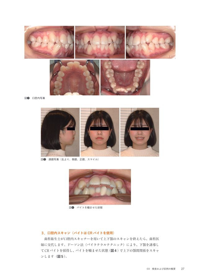 超入門 JET System矯正 Ⅰ級叢生4444抜歯編