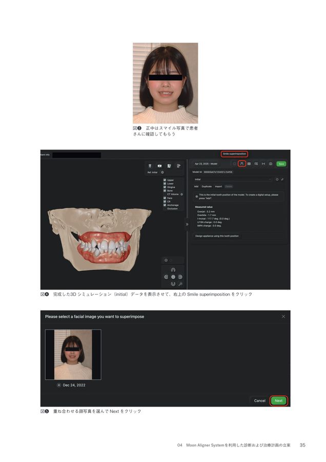 超入門 JET System矯正 Ⅰ級叢生4444抜歯編