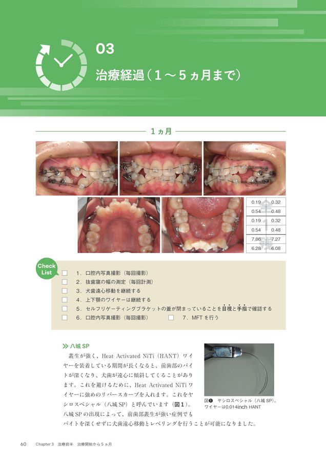 超入門 JET System矯正 Ⅰ級叢生4444抜歯編