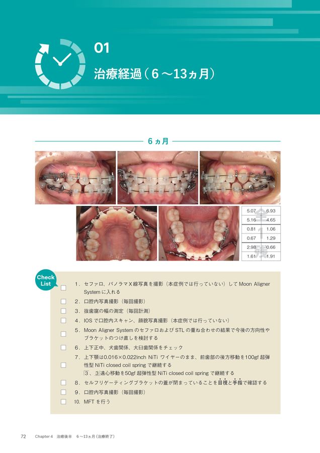 超入門 JET System矯正 Ⅰ級叢生4444抜歯編