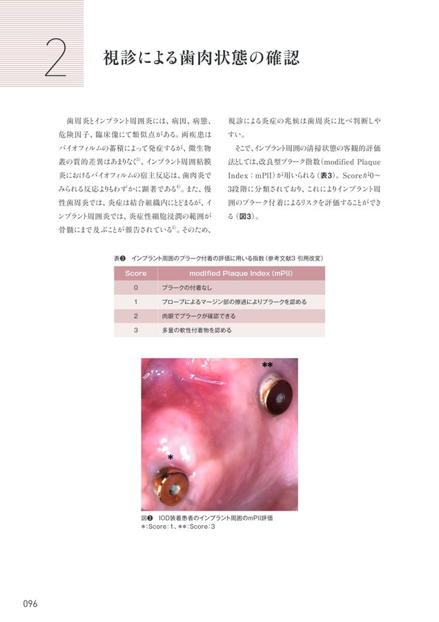 インプラント周囲疾患 診断・予防・対処法